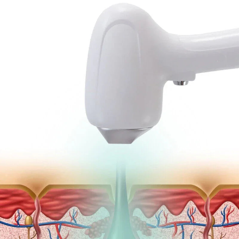 How Does Diode Laser Destroy Hair Follicles Without Damaging the Skin? - Huanshibeauty