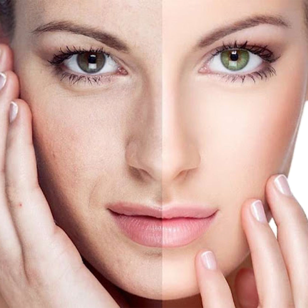 Wrinkle Removal And Skin Tightening