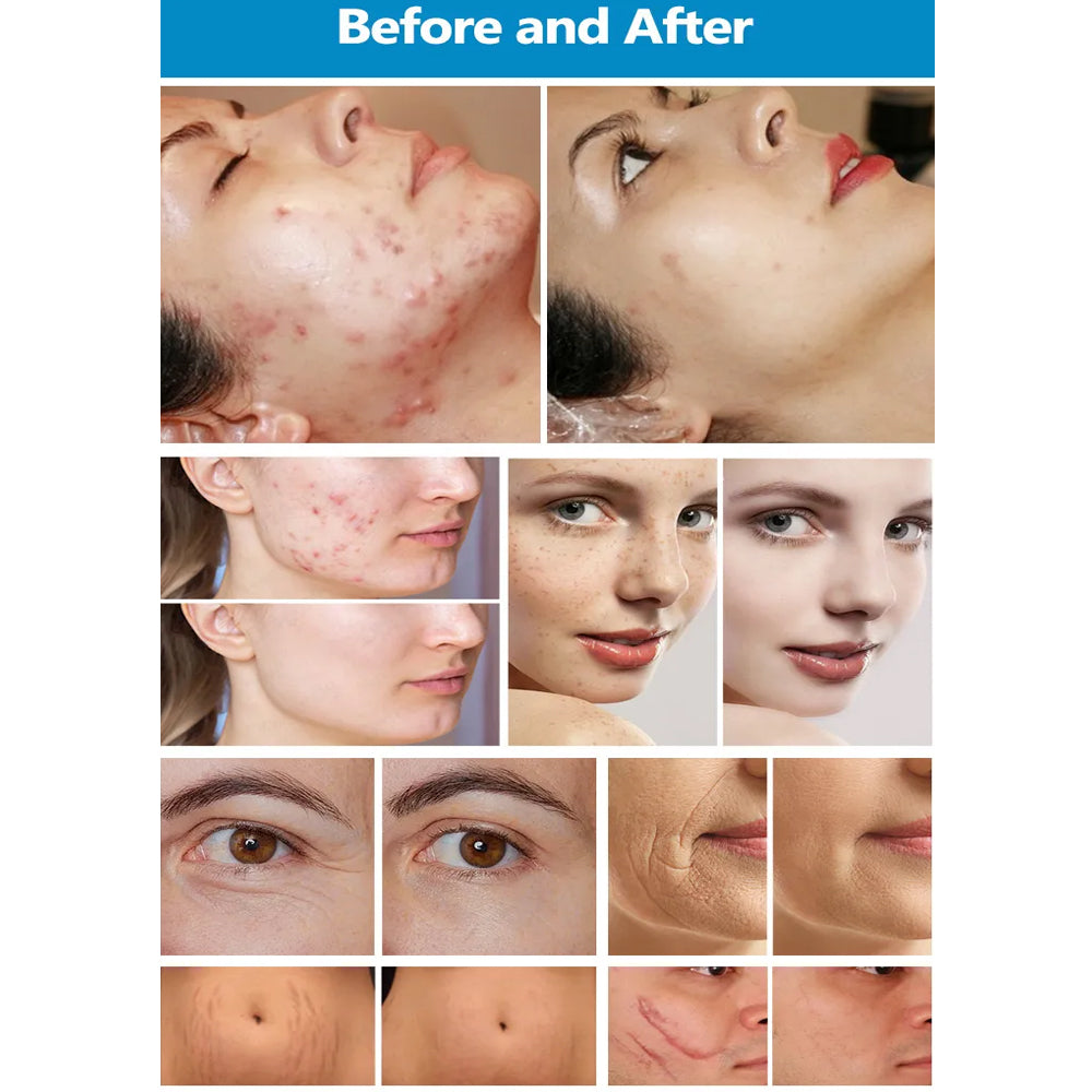 CO2 Fractional Laser Machine for Skin Resurfacing & Beauty Treatments