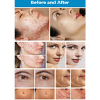 CO2 Fractional Laser Machine for Skin Resurfacing & Beauty Treatments
