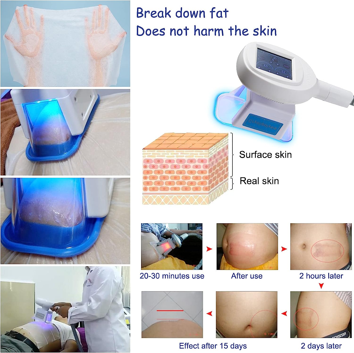 Fat Freezing Cryolipolysis Machine Anti-Cellulite Body Slimming Sculpting Device