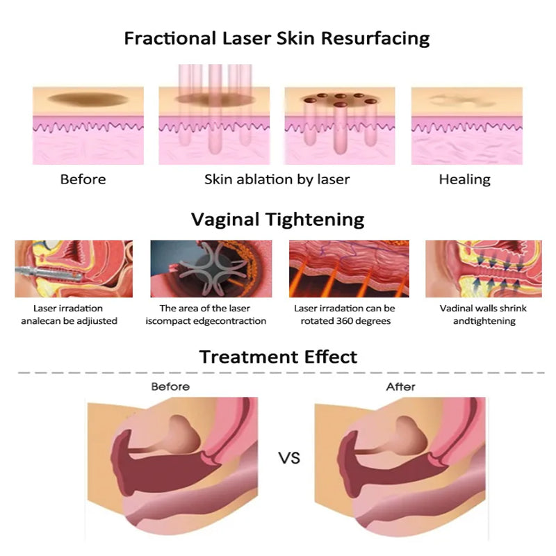CO2 Fractional Laser Machine for Skin Resurfacing & Beauty Treatments