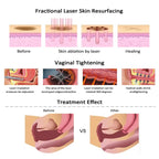 CO2 Fractional Laser Machine for Skin Resurfacing & Beauty Treatments