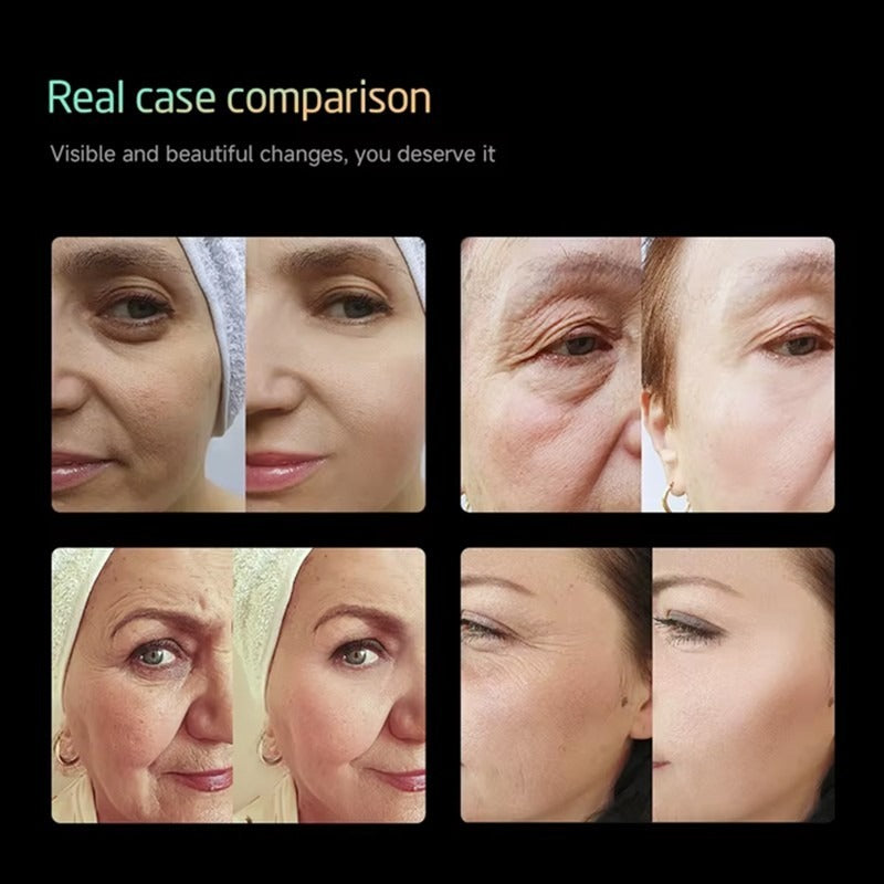 25D 360° Max HIFU Machine Multi-Depth Facial & Body Skin Tightening Device