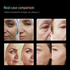 25D 360° Max HIFU Machine Multi-Depth Facial & Body Skin Tightening Device