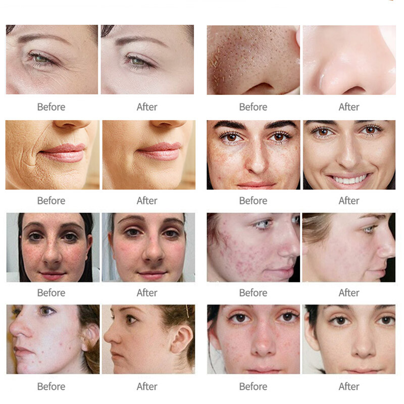 CO2 Fractional Skin Tightening Laser Acnes Scar Removal Skin Resurfacing Machine