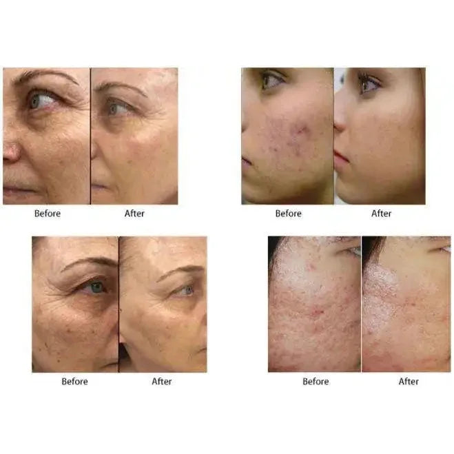Newest M8 RF Microneedle Machine Skin Tightening Wrinkle Removal Face Lift Body Stretch Mark Removal