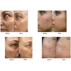 Newest M8 RF Microneedle Machine Skin Tightening Wrinkle Removal Face Lift Body Stretch Mark Removal