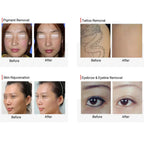 Carbon Peel Picosecond Laser Tattoo Removal Machine Freckle Pigment Removal Skin Rejuvenation