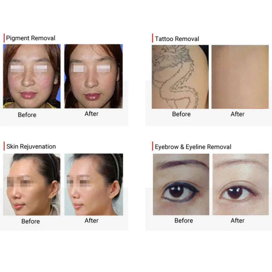 Carbon Peel Picosecond Laser Tattoo Removal Machine Freckle Pigment Removal Skin Rejuvenation