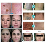Nd YAG Picosecond Laser Tattoo Removal Machine Q Switch Pigment Freckle Removal Skin Rejuvenation