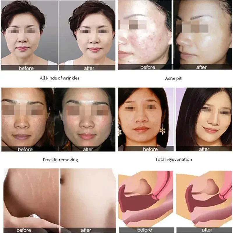 CO2 Fractional Laser Skin Vaginal Tightening Machine Rejuvenation Stretch Marks Removal