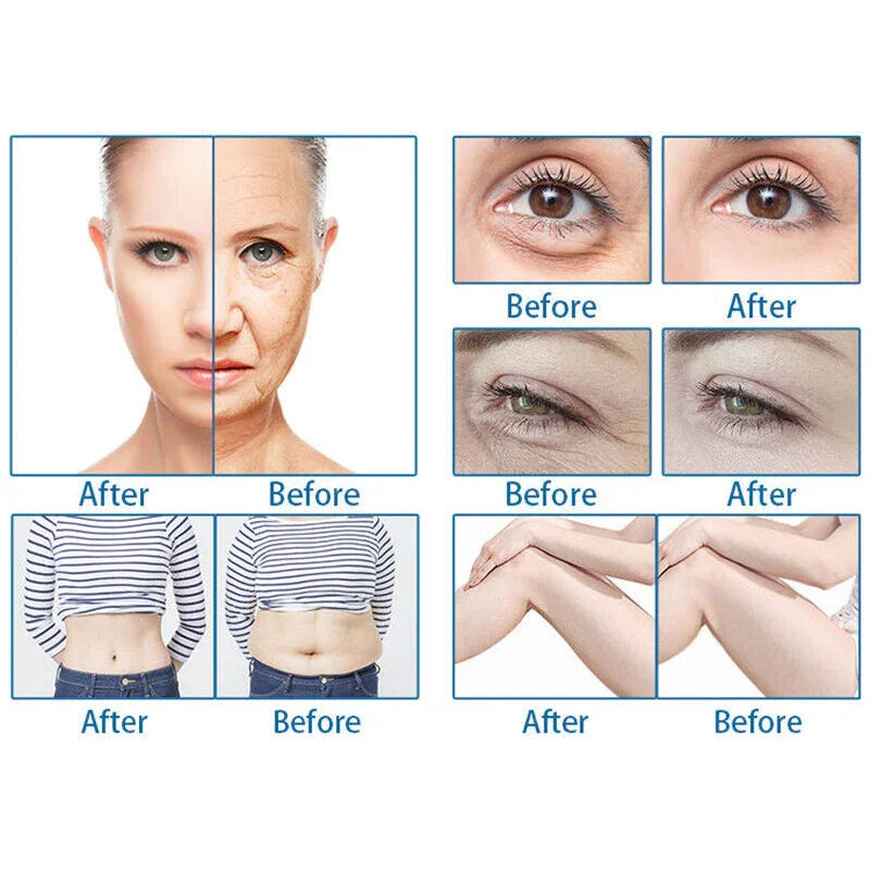 RF Fractional Micro-Needle Beauty Machine Anti-Acne Skin Lifting Anti-Wrinkle