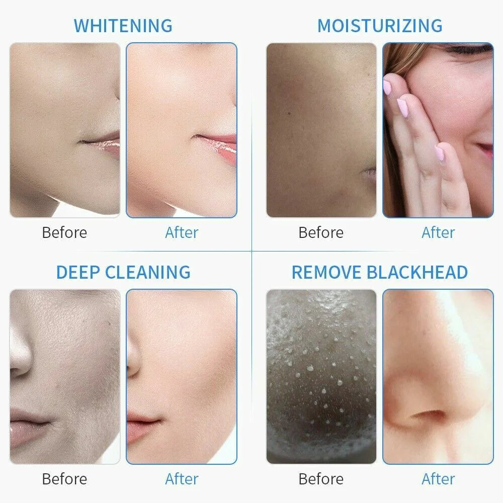 6 In 1 Hydra Machine Facial Water Dermabrasion Deep Cleansing Face Hydro Spa Skin