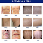 Painless Diode Laser Hair Removal 808/755/1064nm Machine Skin Rejuvenation Summer Beauty