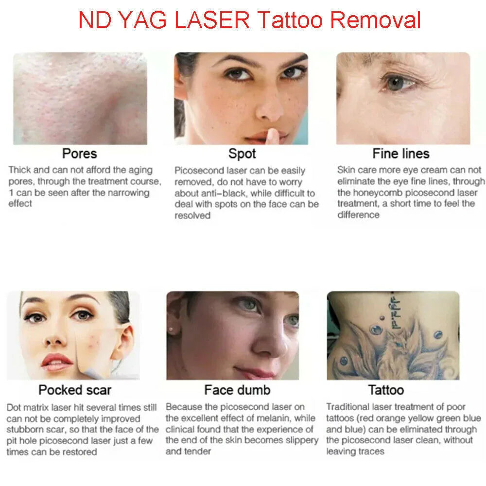 ND YAG Laser Tattoo Removal Pigmentation Treatment Carbon Peeling Beauty Q-switch Machine