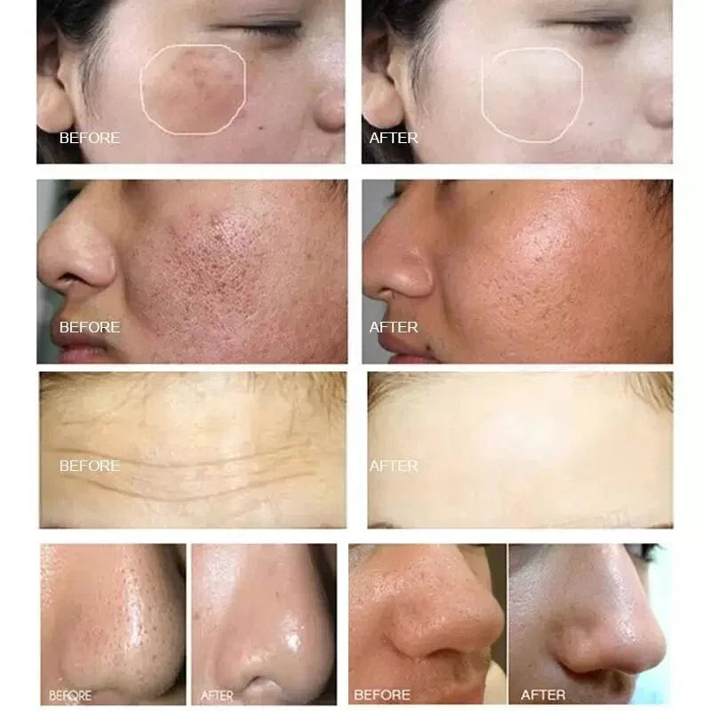 Hydra Machine Water Facial Hydro Face Cleansing Wrinkle Removal Dermabrasion Spa