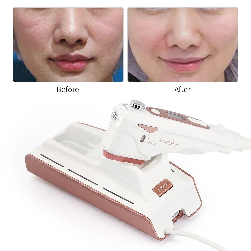 Handheld Ultrasonic HIFU Skin Machine Radio Rejuvenation Face Lifting Anti-aging Secondary image