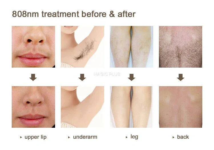 808nm Diode Laser Hair Removal Machine Skin Rejuevantion ND YAG LASER Tattoo Removal