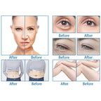 9D Hifu Body SMAS Slimming Face Lifting Machine Wrinkle Removal Skin Tightening