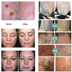 Body Tattoo Removal Picosecond Laser Machine Scar Spot Freckle Mole Remover Skin Rejuvenation Whitening Device