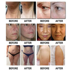 Ultrasound 7D HIFU Machine Facial Tightening Skin Lifting Body Slimming Wrinkle Removal