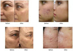 Facial Microneedle Morpheus RF Machine M8 Skin Tightening LIfting Wrinkle Scar Removal