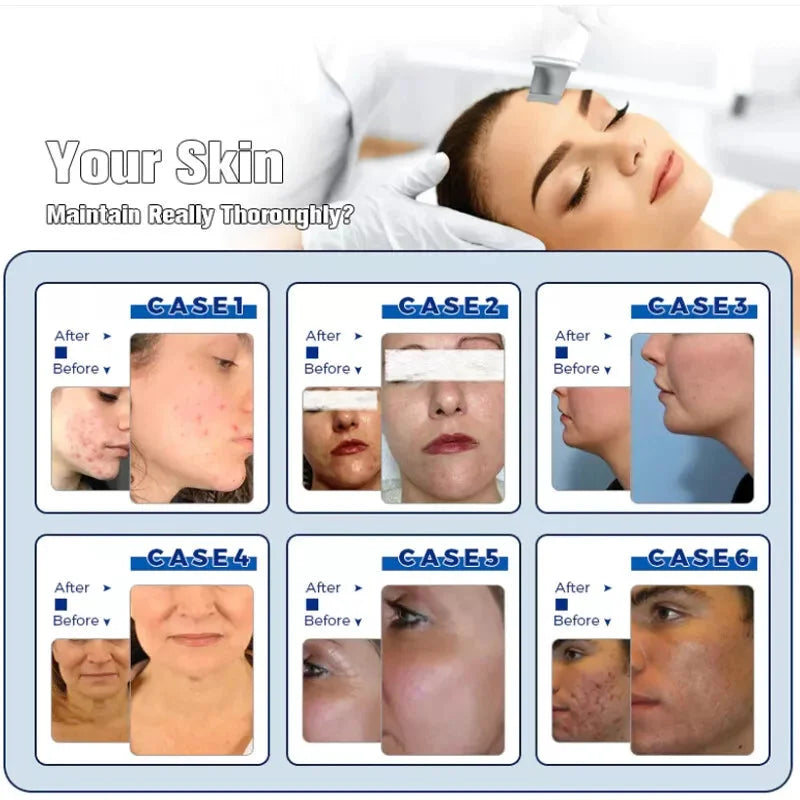14 In 1 HydraFacial Machine RF Hydro Dermabrasion Oxygen Spray Diamond Peeling Skin Care SPA